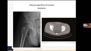 FRACTURA DE MIEMBRO SUPERIOR I EN NIÑOS DR CONGIN 2023 [upl. by Ellehsal]