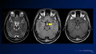 Neuroradiology board review 3 case 6 [upl. by Okimuk]