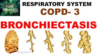 Chronic Obstructive Pulmonary Disease Part 3 Bronchiectasis  Pathology [upl. by Simsar]