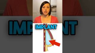 OVER vs UNDER the Muscle Implant Reconstruction breastcancer [upl. by Bbor343]