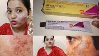 Betnovate C skin cream review Is it safe to use Betnovate dark spots remove skin glowing in Telugu [upl. by Ibbie]