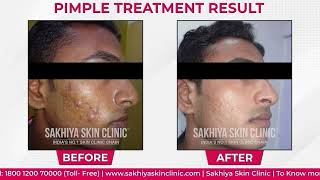 Best Acne Scar Removal Treatments  Real Patient Review amp Success Story  Sakhiya Skin Clinic [upl. by Letnoj]