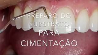 Preparo do dente para a cimentação [upl. by Alarice]