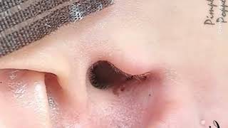 Big Cystic Acne Blackheads Extraction Blackheads amp Removal Pimple Popping MD [upl. by Sophie]