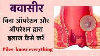 बवासीर  बिना ऑपरेशन और ऑपरेशन द्वारा इलाज कैसे करें  Piles  Hemorrhoids [upl. by Allwein]