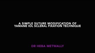 A simple Suture modification on Yamane IOL scleral fixation technique in Pediatric 2ry IOL imp [upl. by Nagey]