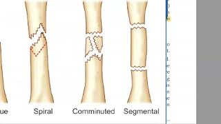 Orthopedics 021 fractures classification types classify [upl. by Rudich]