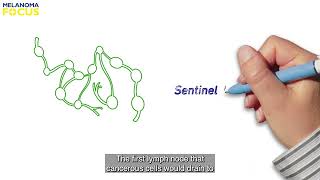 Understanding Sentinel Lymph Node Biopsy  1 of 2 [upl. by Sisto337]