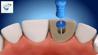 Root Canal Treatment Animation Incisor [upl. by Assenav]