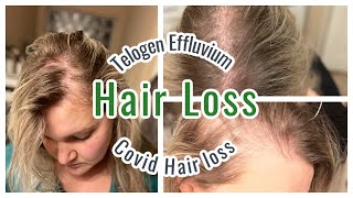 MY HAIR LOSS EXPERIENCE  TELOGEN EFFLUVIUM [upl. by Eitirahc443]