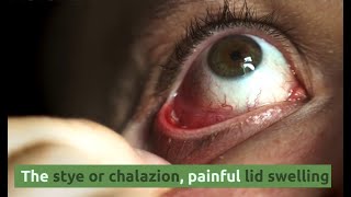 The stye or chalazion painful eyelid [upl. by Larual]