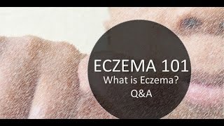 What is Eczema  Eczema Dermatitis Rash Treatment 2015 [upl. by Eliam]