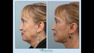 Facelift Experience by Nancy with Dr Edwin Williams [upl. by Irroc]