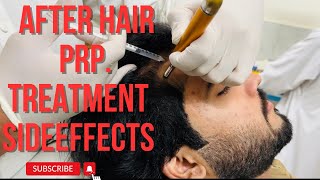 After hair PRP treatment side effects 😰 [upl. by Adnalue]