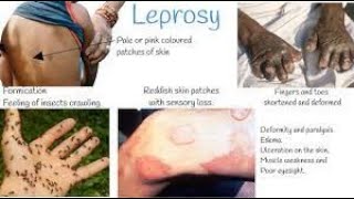 Leprosy  leprosy treatment  Leprosy pathology  hensens disease  leprosy disease [upl. by Staley]