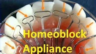 Correcting the Position of Jaws with Homeoblock Appliance by Prof John Mew [upl. by Neukam208]