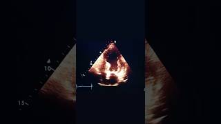 Wall motion abnormalitiesheart attack identification through echo echocardiography heartattack [upl. by Tati]