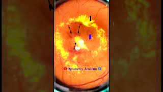 Diabetic Retinopathy  CSME  Retina  Short Video 171 akleshkumar optometrist [upl. by Elegna]