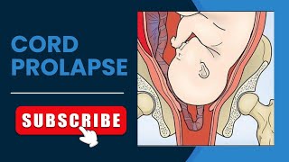 cord prolapse causes signs video nursingdegree obg education biology [upl. by Liv986]