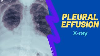 Imaging of pleural effusion For medical students clinicans and residents [upl. by Akinyt852]