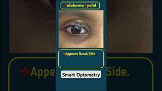 Eyelid Coloboma optometry optometrist optometrists optometrista eyedisease eyediseases eyelid [upl. by Inaflahk]