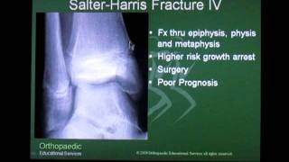 Salter Harris Fracture  Pediatrics [upl. by Halyak]