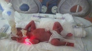 Born at 25 Weeks MicroPreemie Documentary [upl. by Yroc]