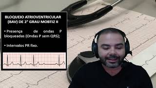 Bloqueio Atrioventricular BAV de 2° Grau Mobitz II [upl. by Dopp]