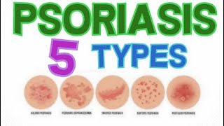 THE 5 MAIN TYPES OF PSORIASIS  PSORIASIS CLASSIFICATION [upl. by Darnell]