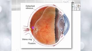 Vitreous anatomy and functions [upl. by Aramanta534]