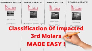 Classification of Impacted 3rd Molars  Oral Surgery [upl. by Herold]