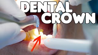 Dental Crown Procedure EXPLAINED [upl. by Gaynor]