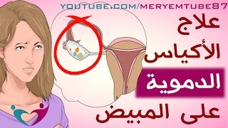 علاج الأكياس الدموية على المبيض [upl. by Iiette608]