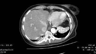 CASE 947 CT AORTOGRAPHY DISSECTING THORACIC AORTIC ANEURYSM [upl. by Kellina554]