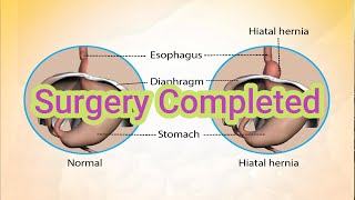 My Experience with Hiatal Hernia Repair and Nissan Fundoplication [upl. by Favata]