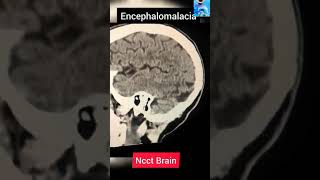 Ct scan Brain findings [upl. by Cole]