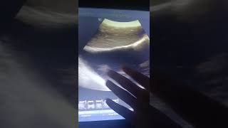 fefde lung me Pani Effusion kya hota h Ultrasound me pleural effusion kya h pleural effusion [upl. by Atinaj]