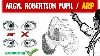 Exploring Argyl Robertson Pupil and ARP Syphilitic Pupil  Light near dissociation [upl. by Kenny]