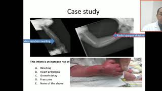 Case 58 soft tissue swelling due calcium extravasation [upl. by Haisoj]