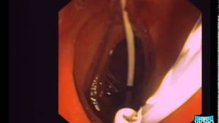 OvertheWire Stent Exchange Using a Simple Snare Technique in ERCP [upl. by Ruvolo]