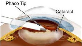 Phacoemulsification for Cataract  All you want to know about cataract surgery [upl. by Aihtnyc]