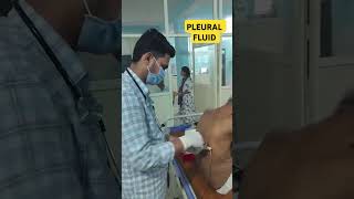 PLEURAL FLUID  Drain tb cancer drsatyampathak doctor medicotips pleuralfluid lungs cough [upl. by Trebor401]