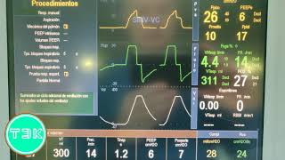 GE Engstrom Carestation Respiratory Ventilator [upl. by Anomer]