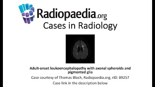 Adultonset leukoencephalopathy Radiopaediaorg Cases in Radiology [upl. by Lamori]