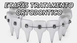 Quais as etapas de um tratamento ortodôntico [upl. by Etterrag]