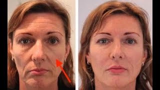 How Cheek Filler unlocks the mid face in minutes [upl. by Cocke]