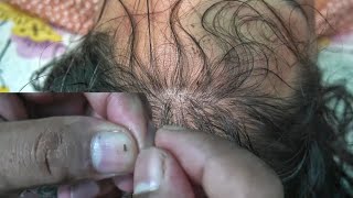 Lice and Nits Picking From Head  Best Lice Killing Method [upl. by Etnemelc54]