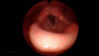 Sleep Unilateral Vocal Cord Paresis [upl. by Alenson]