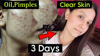 10 Pimple Mistakes  How To Remove Pimples From Face  Remove Dark Spots amp Pimples Naturally [upl. by Keyser]