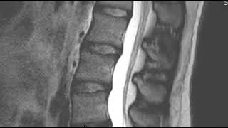 How to Read an MRI Scan of the Lumbar Spine  First Look MRI [upl. by Garcia705]